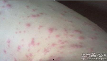 吃白瓜过敏怎么办,紧急处理与预防措施指南